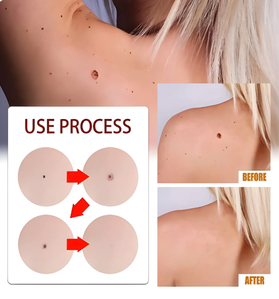 Tags & Moles Remover (Pack of 2) - ChooseMyKart