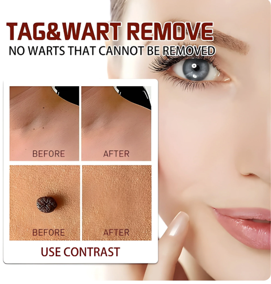 Tags & Moles Remover (Pack of 2) - ChooseMyKart